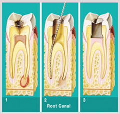 Root-Canal1